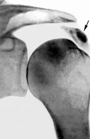 Плечелопаточный периартрит рентген снимок